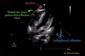 Fluid in the subcostal cardiac view – NephroPOCUS