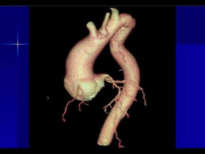 What is Thoracic Aortic Disease?