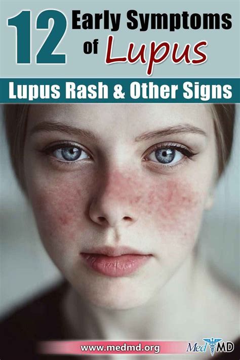 Lupus Symptoms Face Rash Remedies, Subacute Cutaneous Lupus, Systemic Autoimmune Disease ...