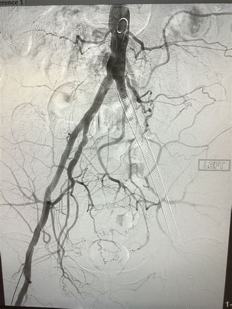 Acute arterial occlusion | Interventional radiology, Radiology