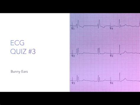 ECG Quiz #3: Bunny Ears - YouTube