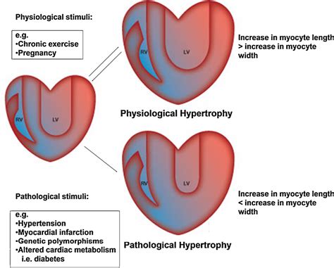 Molecular regulation of cardiac hypertrophy. | Semantic Scholar