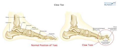 Claw Toe | Rehab My Patient