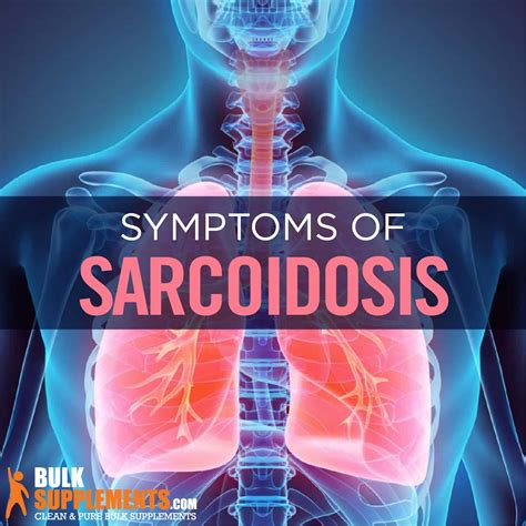 Sarcoidosis: Symptoms, Causes & Treatments