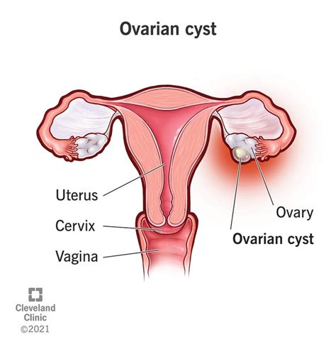 Ovarian Cysts: Causes, Symptoms, Diagnosis & Treatment