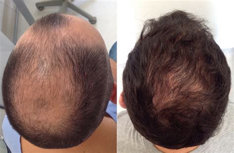 FUE hair Transplant before and after crown | IK Clinics