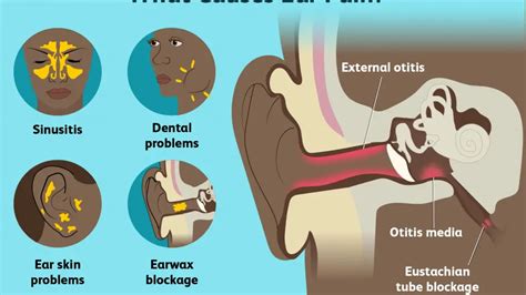 12 Ways on How to Pop Your Ears - Pulsatile Tinnitus