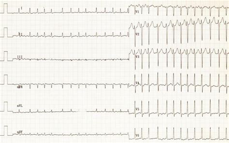 New AHA treatment guidelines for use of blood thinners with atrial fibrillation