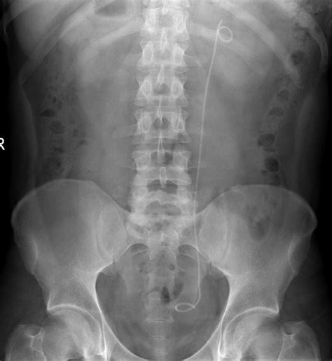 Ureteric stent - Radiology at St. Vincent's University Hospital