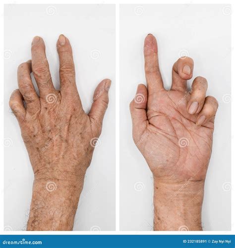 Ulnar Claw Hand Of Asian Old Man. Also Known As `spinster`s Claw Stock ...