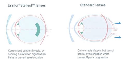 Essilor Stellest Lens - Evershine Optical