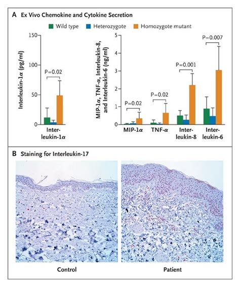 An Autoinflammatory Disease with Deficiency of the Interleukin-1–Receptor Antagonist | NEJM