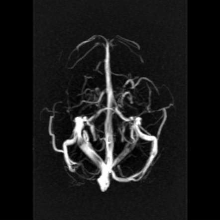 Occipital sinus | Radiology Reference Article | Radiopaedia.org