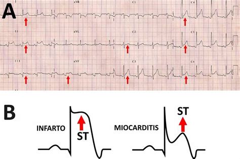 ¿Cómo es el ECG en las pericarditis?