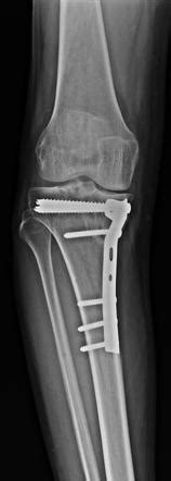 Postoperative genu varus | Radiology Case | Radiopaedia.org