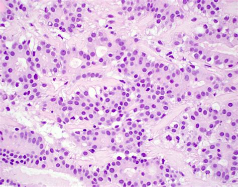 Adenomiosis Histology