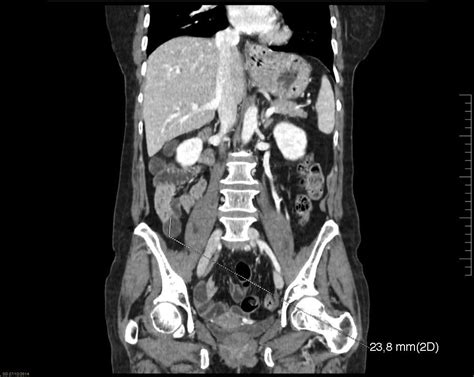 No rotación intestinal del adulto como causante de cuadro de dolor ...