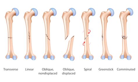 Distal Femur Fracture Classification / Periarticular Fractures of the Knee in Polytrauma ...