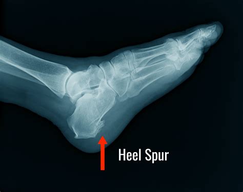 Three reasons why your Heel Spur is not causing your heel pain! | Foot Right Podiatry