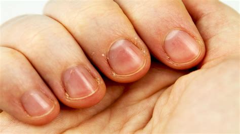 What Causes Keratin Build Up On Nails - Nail Ftempo