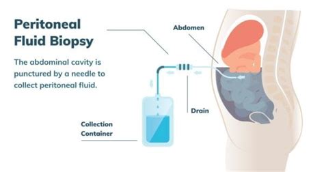 Peritoneal Mesothelioma | Treatment, Prognosis & Diagnosis