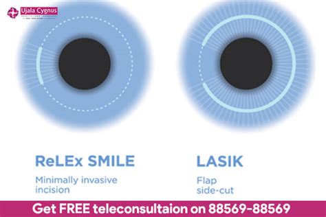 LASIK vs SMILE - Ujala Cygnus