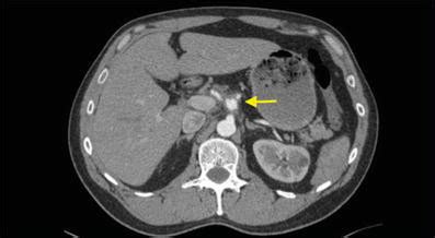 Celiac artery saccular aneurysm in a 49-year-old male, with sudden... | Download Scientific Diagram