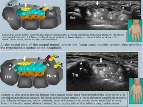 Presentation1.pptx, ultrasound examination of the wrist joint.