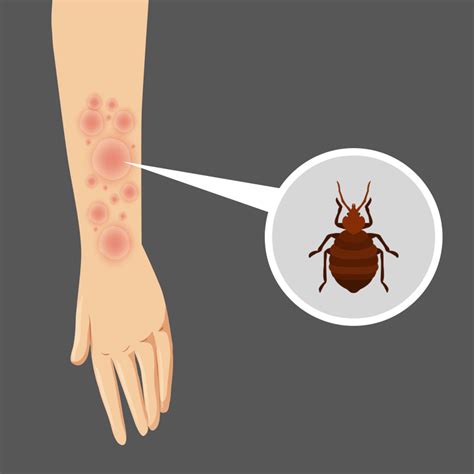 How To Treat Allergic Reaction To Bed Bug Bites - Bed Western