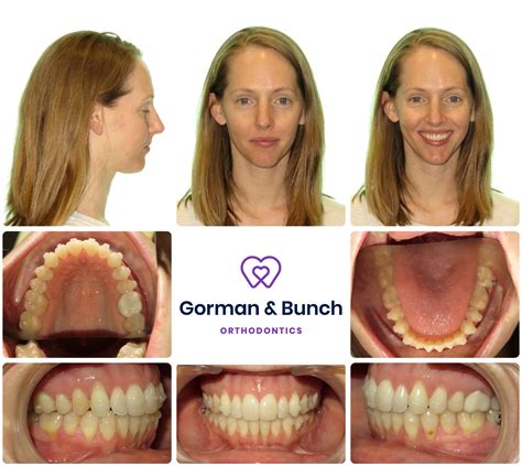 Invisalign Before and After Stories With Our Patients – Gorman & Bunch