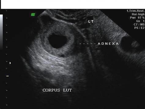 Ultrasound image gallery | Ultrasound, Ovaries, Corpus luteum