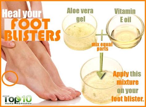 Home Remedies for Foot Blisters - Page 3 of 3 | Top 10 Home Remedies