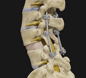 Spondylolisthesis Reduction & Fusion | Advanced Orthopaedics & Sports Medicine, Orthopaedic ...