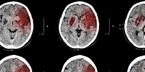 Cerebral Infarction: What Is Cerebral Infarction?