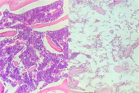 Chemotherapy-free stem cell transplant promises safer leukemia treatment