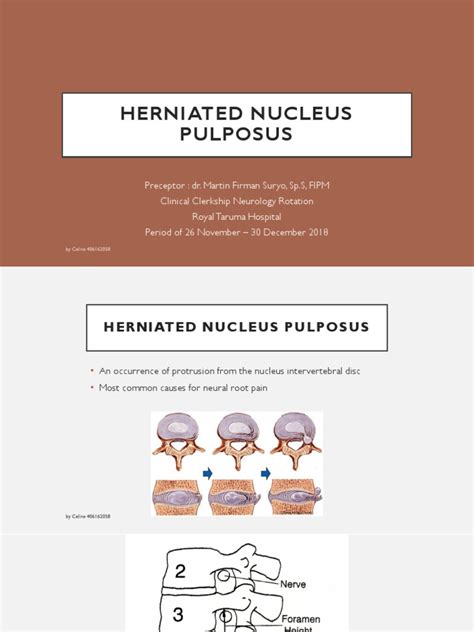 Herniated Nucleus Pulposus (HNP) | Back Pain | Symptoms And Signs