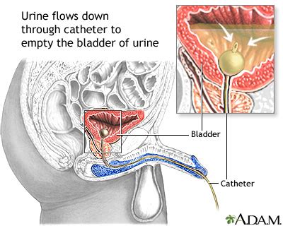 how to use catheter in male - Niesha Velez