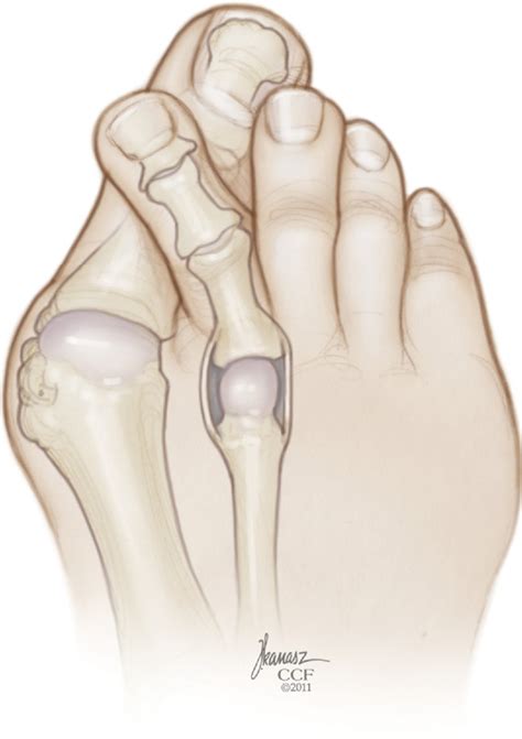 Figure 3 from The crossover toe and valgus toe deformity. | Semantic Scholar