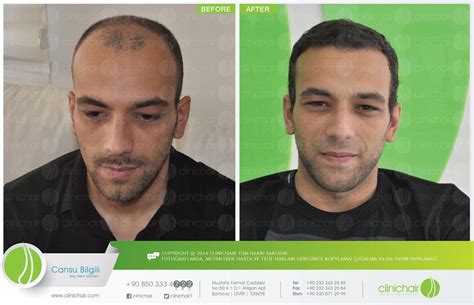 Photo gallery of Clinichair Hair Transplant Center - medical centers ...