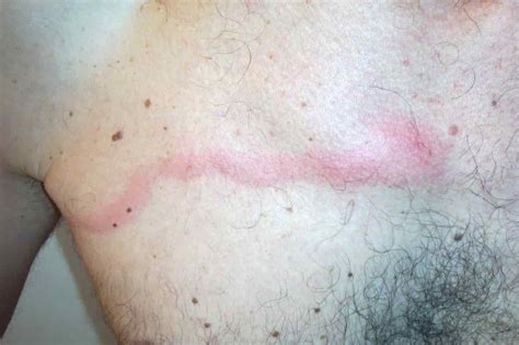 Mondor Disease - www.medicoapps.org