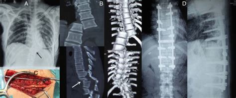 A rare case of complete T10–T11 fracture and dislocation with the neurologic signs of Frankel D ...