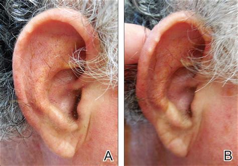 Using the Blanch Sign to Differentiate Weathering Nodules From Auricular Tophaceous Gout ...