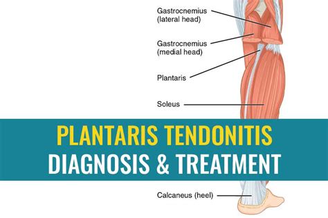 Understanding plantaris tendon pain, how it affects the Achilles, and how to treat it