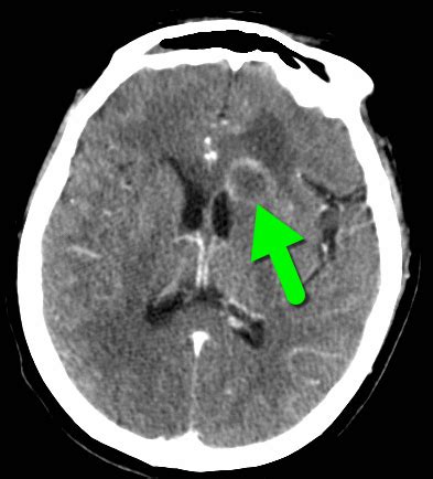 Differential diagnosis of a ring-enhancing lesion?