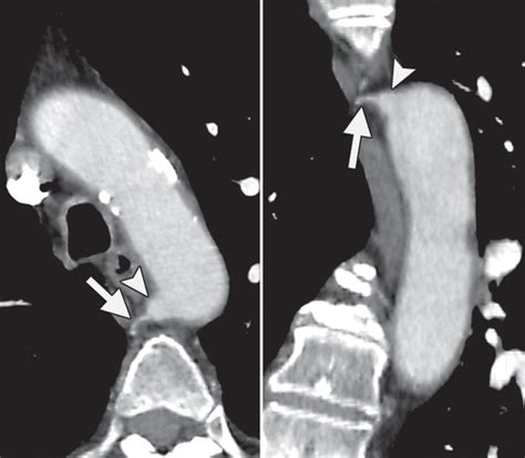 Bronchial Arteries: Anatomy, Function, Hypertrophy, and Anomalies | RadioGraphics