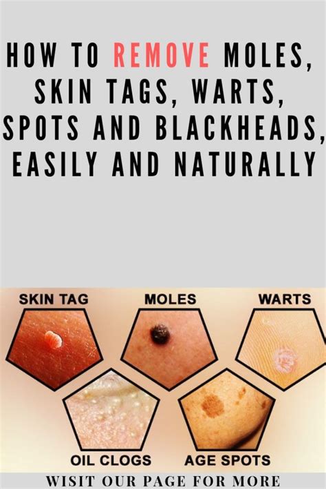 How To Remove Moles, Skin Tags, Warts, Spots And Blackheads, Easily and Naturally (With images ...