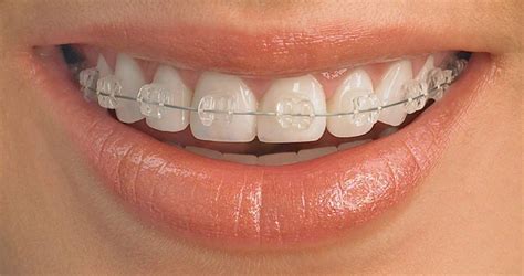 Ceramic Braces – Queensgate Dental Practice