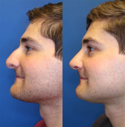 Nose Surgery Before & After Photos Patient 224 | San Francisco, CA | Kaiser Permanente Cosmetic ...