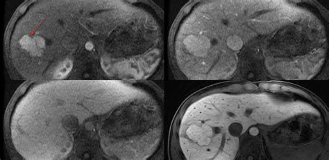 Focal nodular hyperplasia liver causes, symptoms, diagnosis & treatment