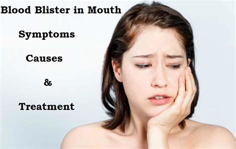 Blood Blister in Mouth: Symptoms, Causes, & Treatment - Health Argue